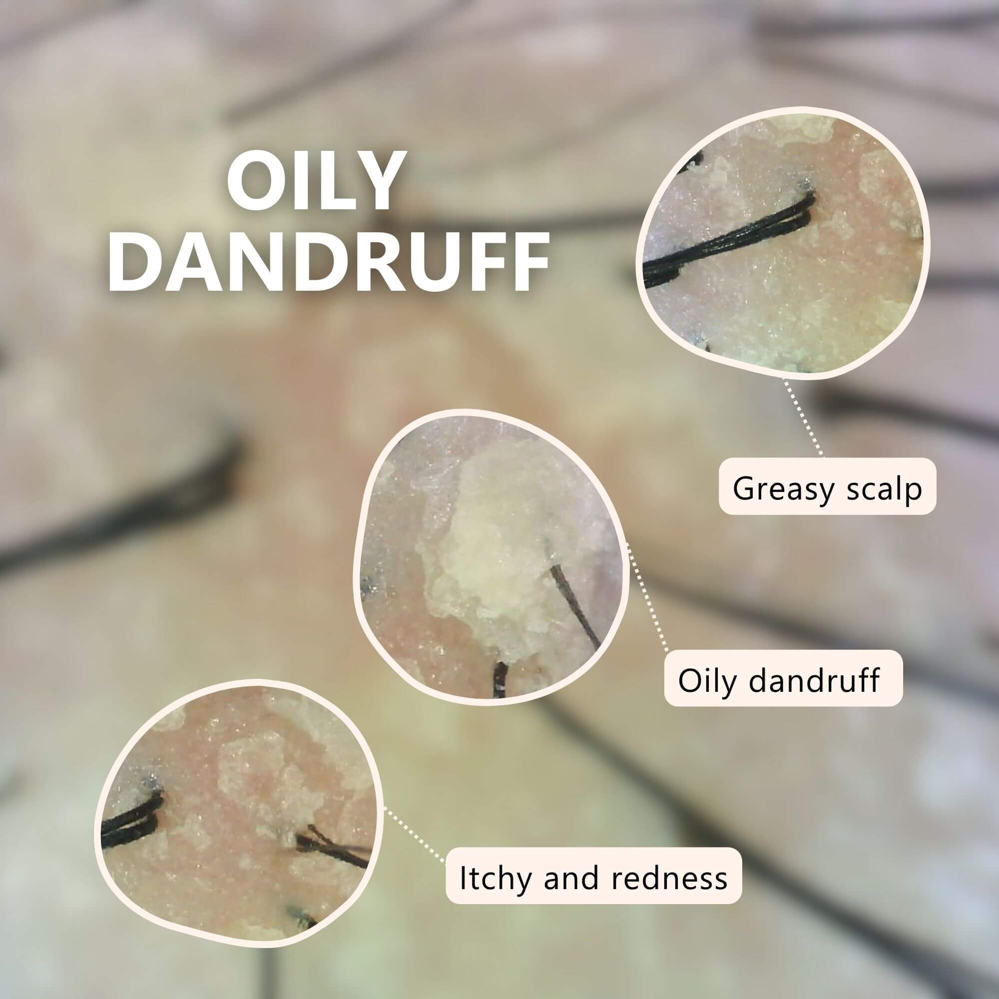 AROMASE-oily-scalp-balancing-shampoo-for-oily-dandruff-greasy-hair-itchy-scalp-itchy-hair